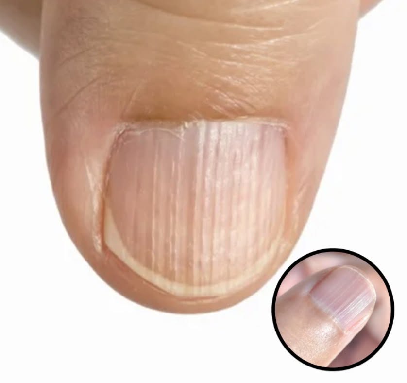 Doctor Explains What It Means If You Have Ridges On Your Fingernails